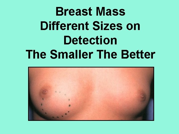 Breast Mass Different Sizes on Detection The Smaller The Better 