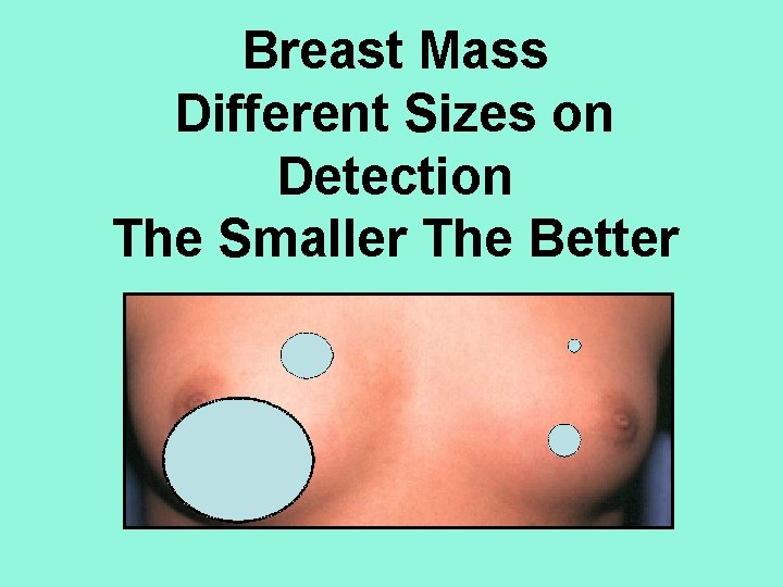 Breast Mass Different Sizes on Detection The Smaller The Better 