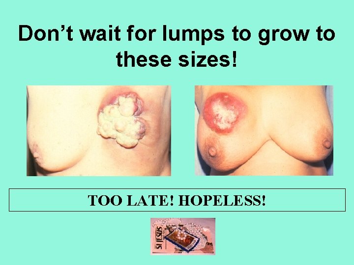 Don’t wait for lumps to grow to these sizes! TOO LATE! HOPELESS! 