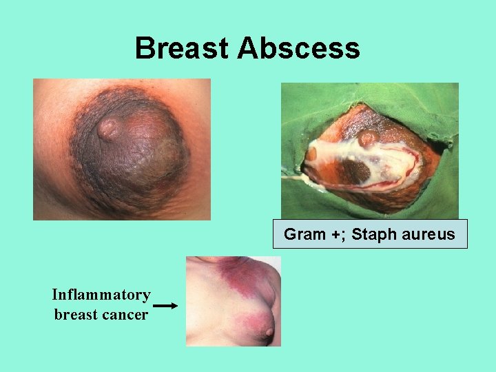 Breast Abscess Gram +; Staph aureus Inflammatory breast cancer 