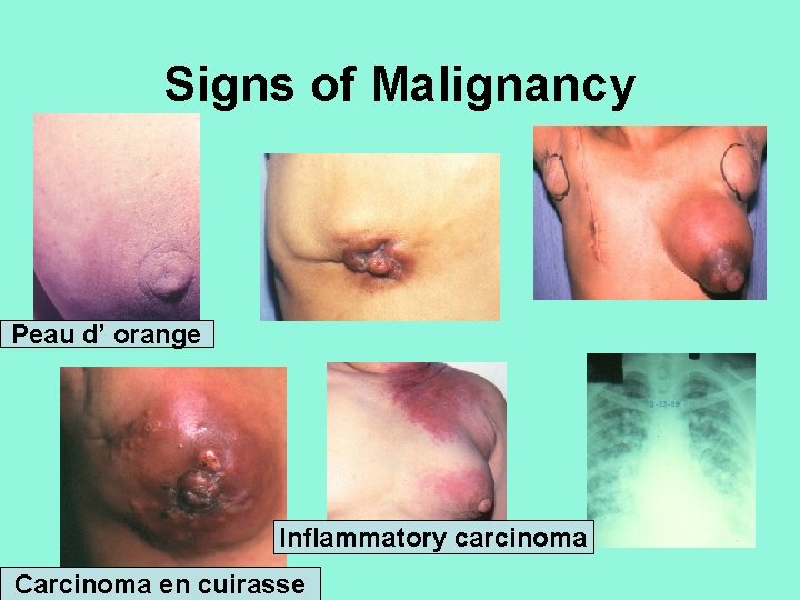 Signs of Malignancy Peau d’ orange Inflammatory carcinoma Carcinoma en cuirasse 