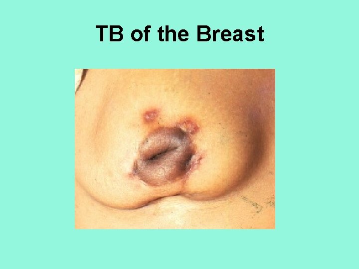 TB of the Breast 