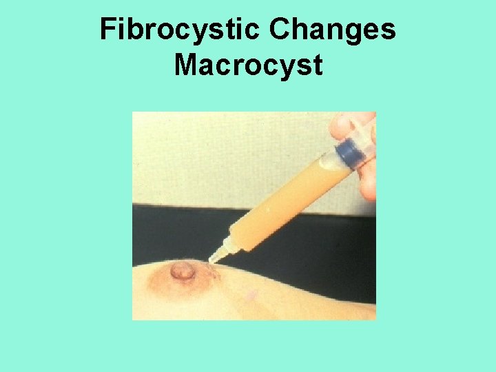 Fibrocystic Changes Macrocyst 