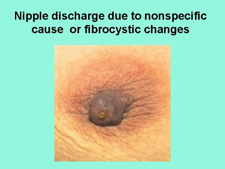 Nipple discharge due to nonspecific cause or fibrocystic changes 