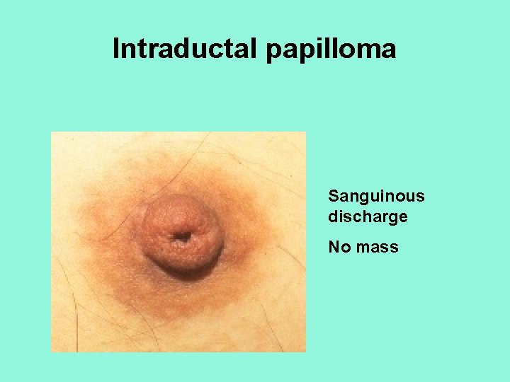 Intraductal papilloma Sanguinous discharge No mass 