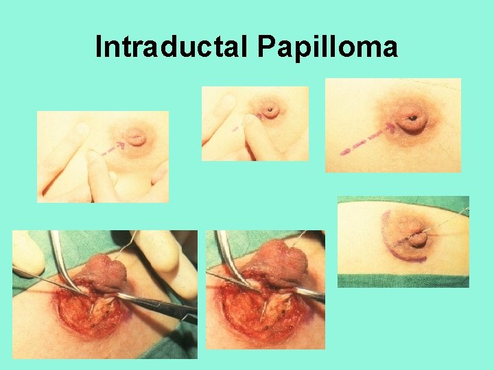 Intraductal Papilloma 