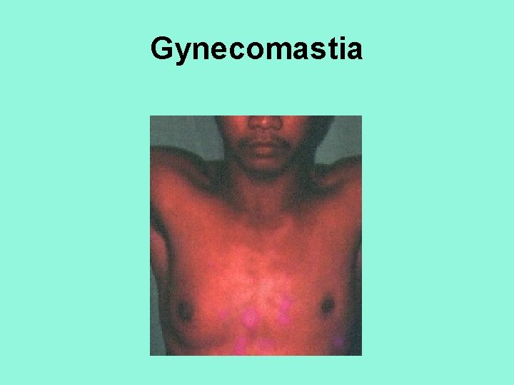 Gynecomastia 