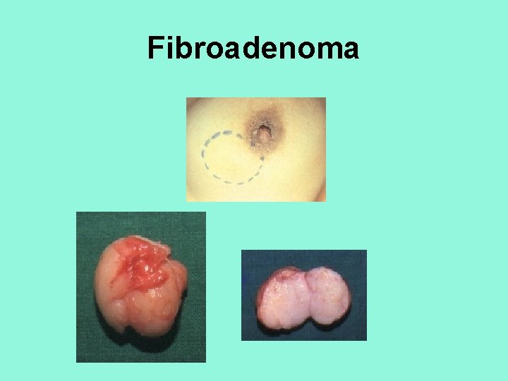 Fibroadenoma 
