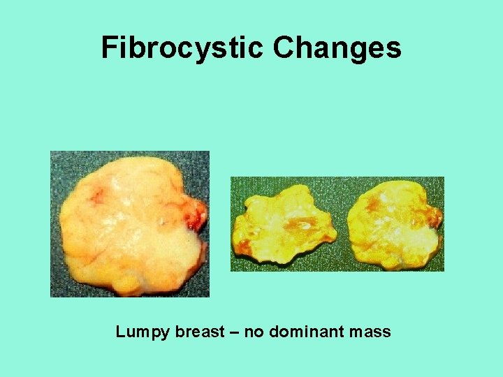 Fibrocystic Changes Lumpy breast – no dominant mass 