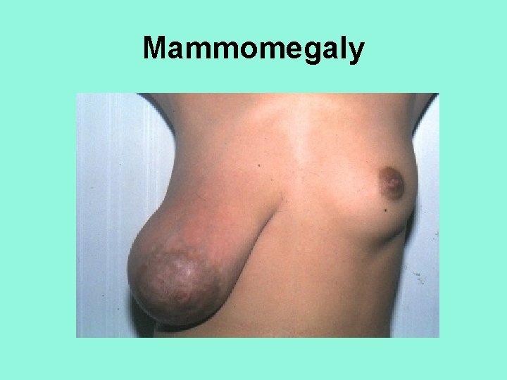 Mammomegaly 