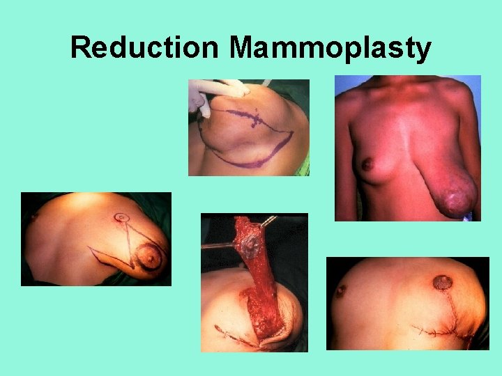 Reduction Mammoplasty 