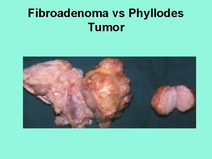 Fibroadenoma vs Phyllodes Tumor 