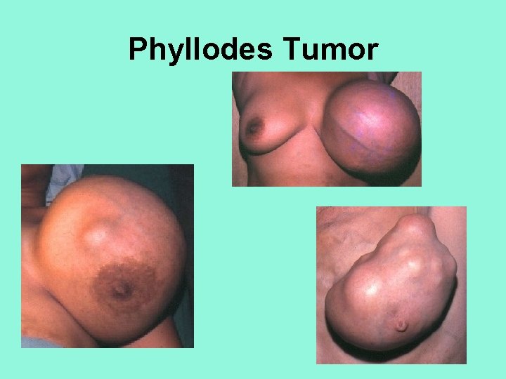 Phyllodes Tumor 