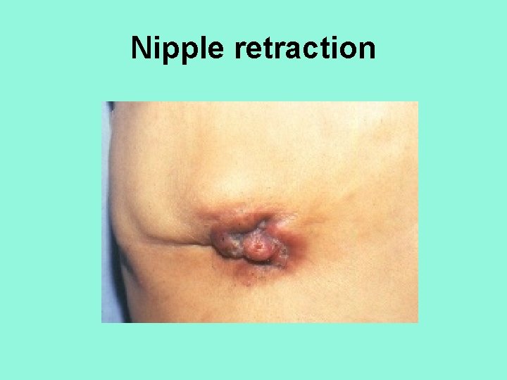 Nipple retraction 