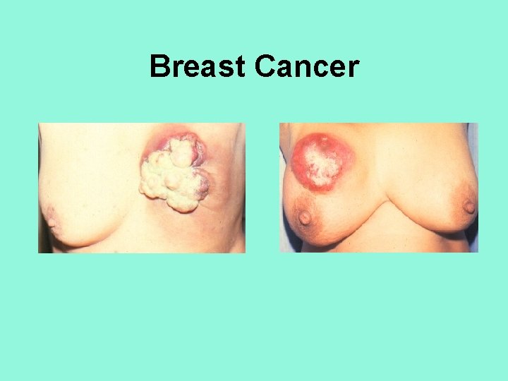 Breast Cancer 