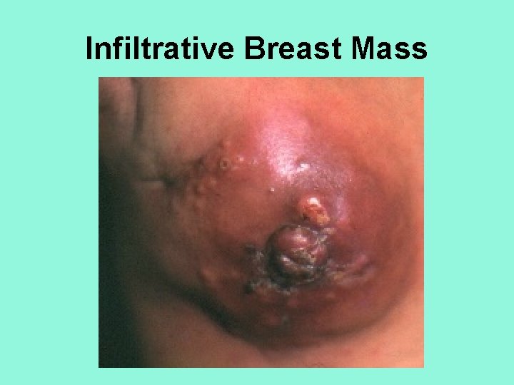 Infiltrative Breast Mass 