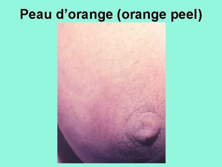 Peau d’orange (orange peel) 