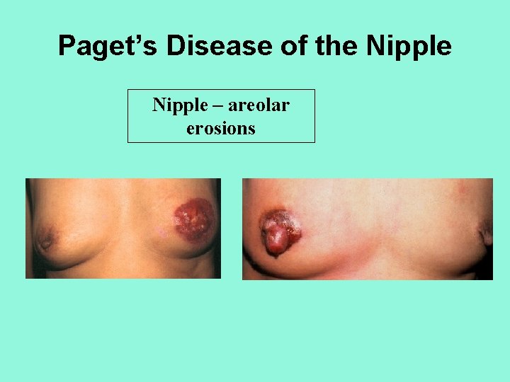 Paget’s Disease of the Nipple – areolar erosions 