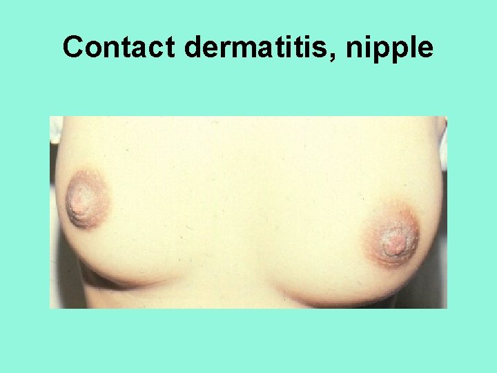 Contact dermatitis, nipple 