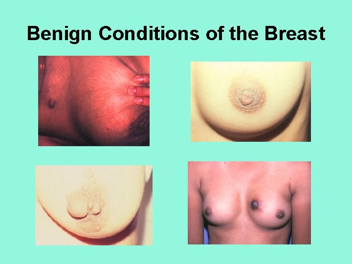 Benign Conditions of the Breast 