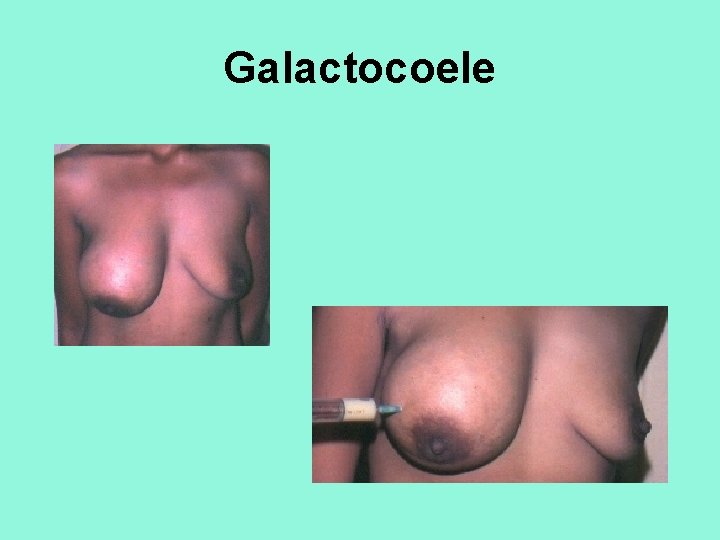 Galactocoele 