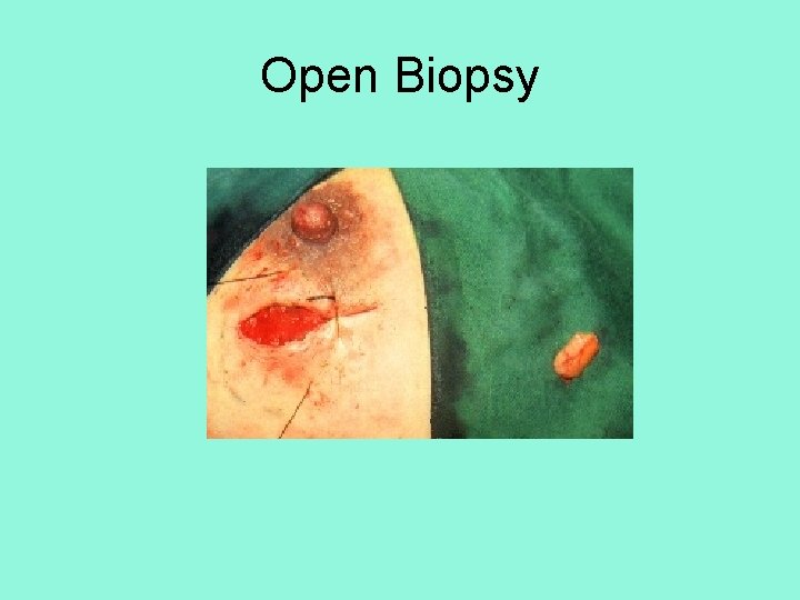 Open Biopsy 