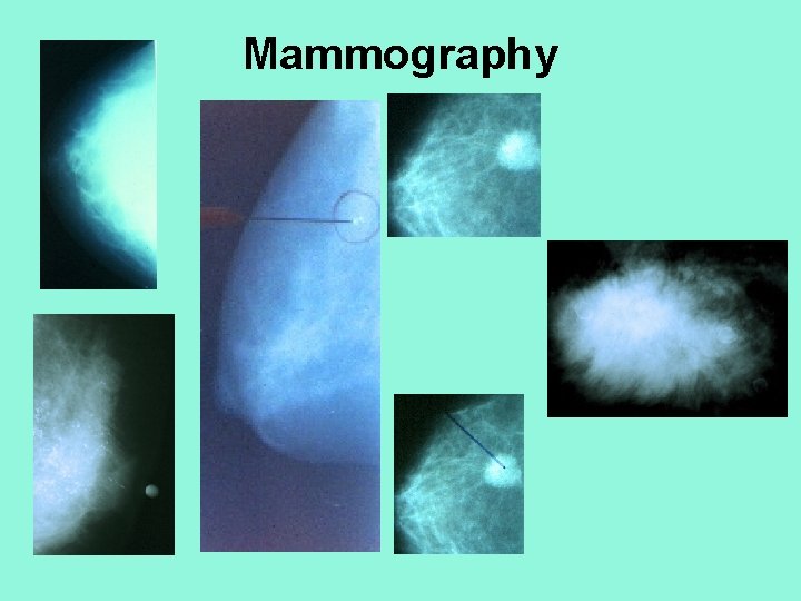 Mammography 