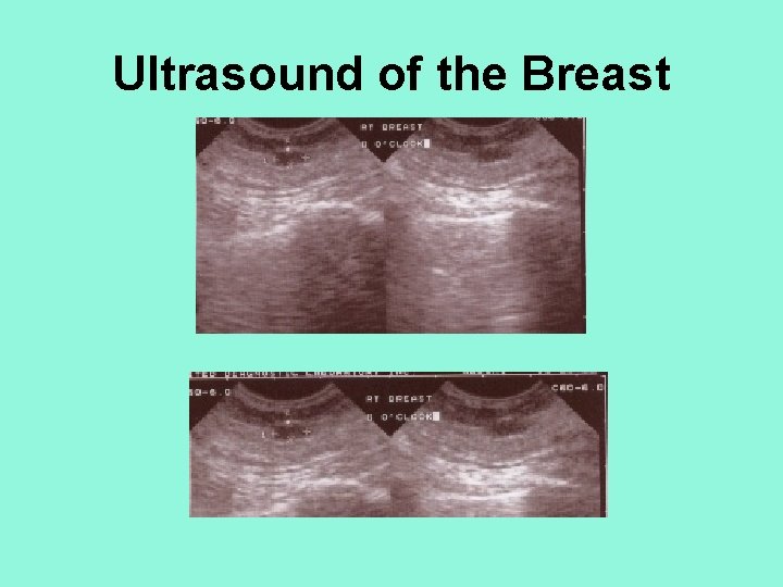 Ultrasound of the Breast 