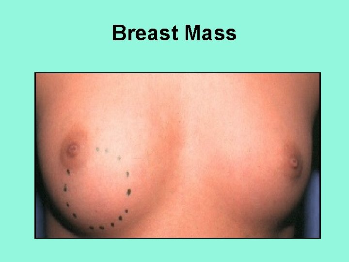 Breast Mass 
