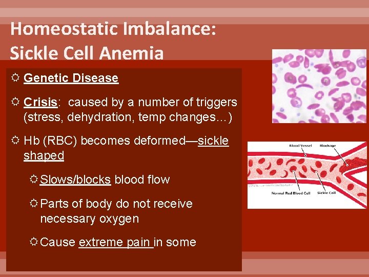 Homeostatic Imbalance: Sickle Cell Anemia Genetic Disease Crisis: caused by a number of triggers