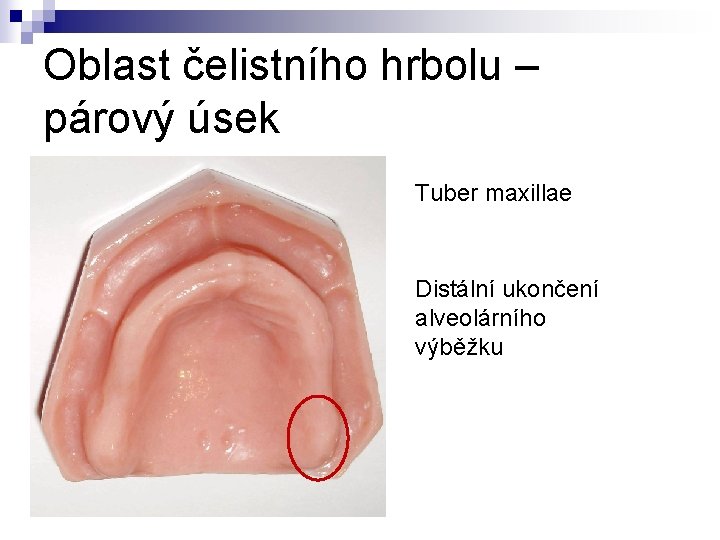 Oblast čelistního hrbolu – párový úsek Tuber maxillae Distální ukončení alveolárního výběžku 