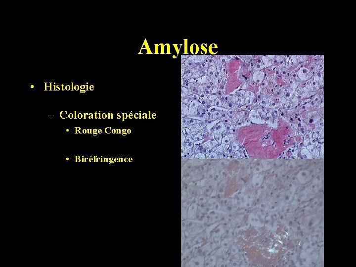 Amylose • Histologie – Coloration spéciale • Rouge Congo • Biréfringence 