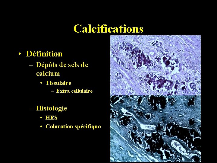 Calcifications • Définition – Dépôts de sels de calcium • Tissulaire – Extra cellulaire