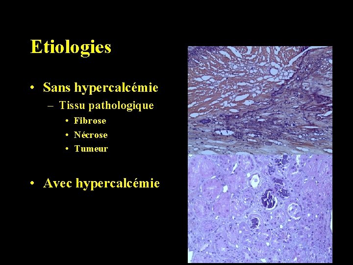 Etiologies • Sans hypercalcémie – Tissu pathologique • Fibrose • Nécrose • Tumeur •