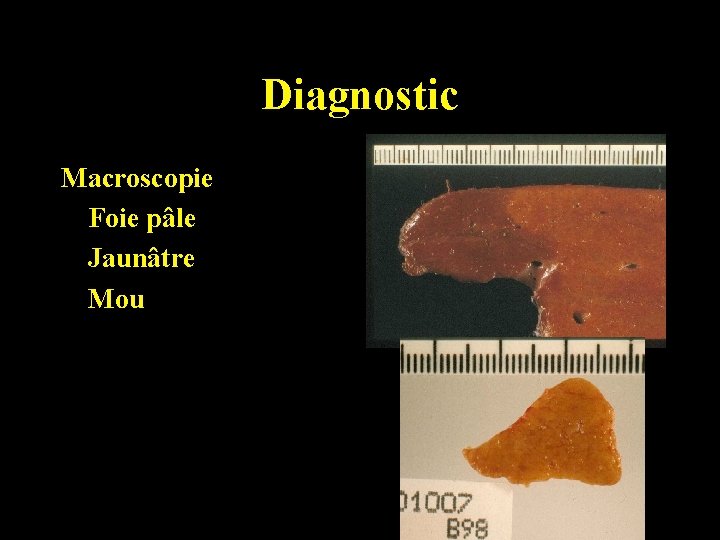 Diagnostic Macroscopie Foie pâle Jaunâtre Mou 