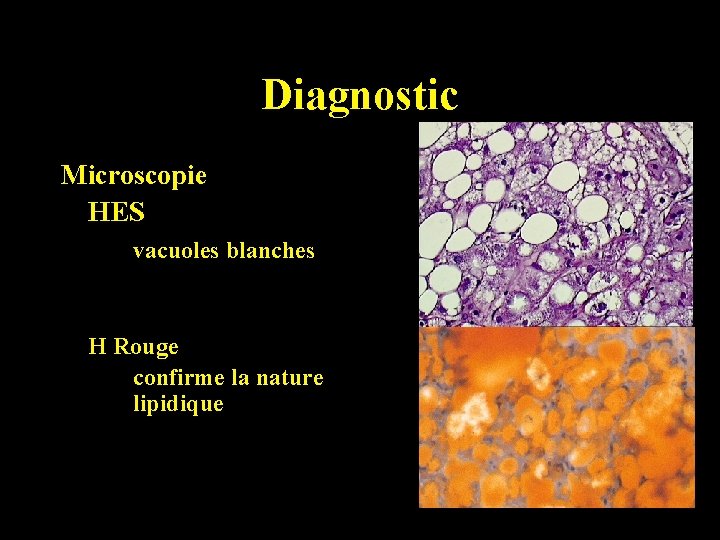 Diagnostic Microscopie HES vacuoles blanches H Rouge confirme la nature lipidique 