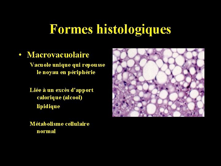 Formes histologiques • Macrovacuolaire Vacuole unique qui repousse le noyau en périphérie Liée à