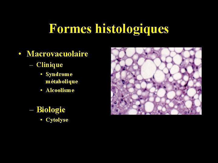 Formes histologiques • Macrovacuolaire – Clinique • Syndrome métabolique • Alcoolisme – Biologie •