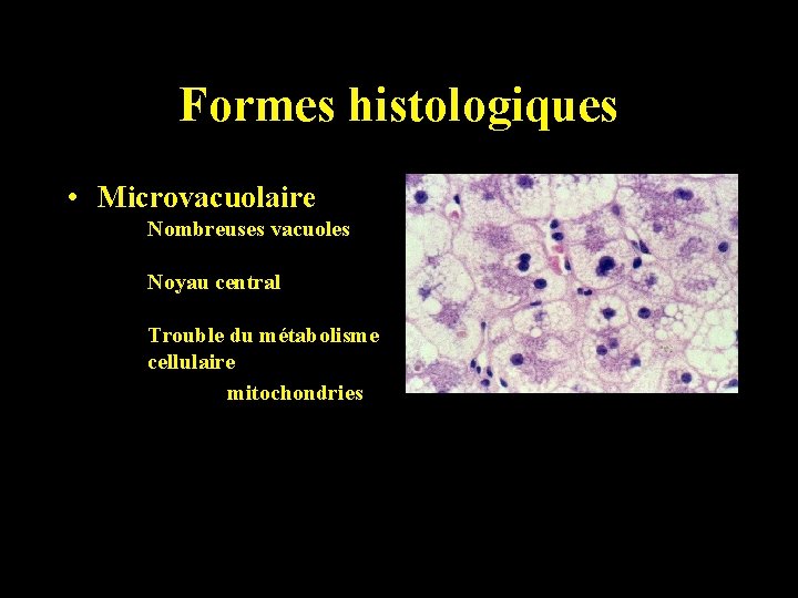 Formes histologiques • Microvacuolaire Nombreuses vacuoles Noyau central Trouble du métabolisme cellulaire mitochondries 