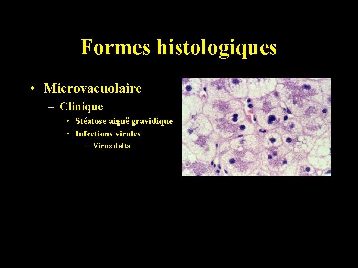 Formes histologiques • Microvacuolaire – Clinique • Stéatose aiguë gravidique • Infections virales –