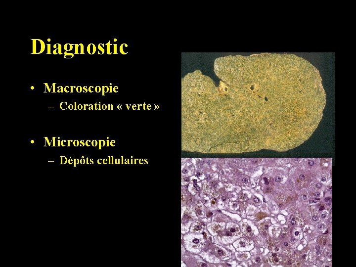 Diagnostic • Macroscopie – Coloration « verte » • Microscopie – Dépôts cellulaires 
