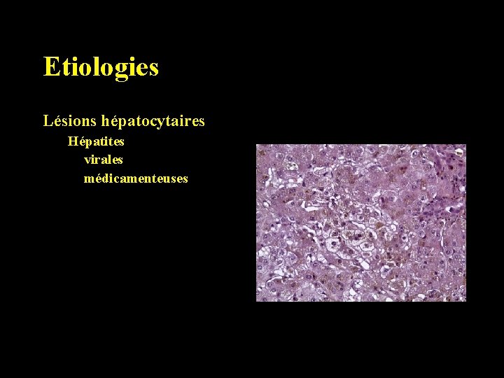 Etiologies Lésions hépatocytaires Hépatites virales médicamenteuses 