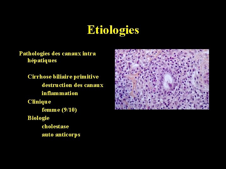 Etiologies Pathologies des canaux intra hépatiques Cirrhose biliaire primitive destruction des canaux inflammation Clinique