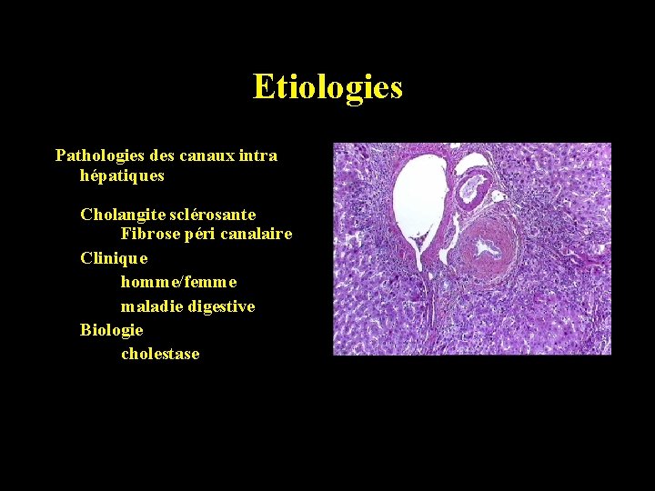 Etiologies Pathologies des canaux intra hépatiques Cholangite sclérosante Fibrose péri canalaire Clinique homme/femme maladie