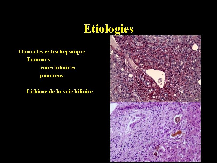Etiologies Obstacles extra hépatique Tumeurs voies biliaires pancréas Lithiase de la voie biliaire 
