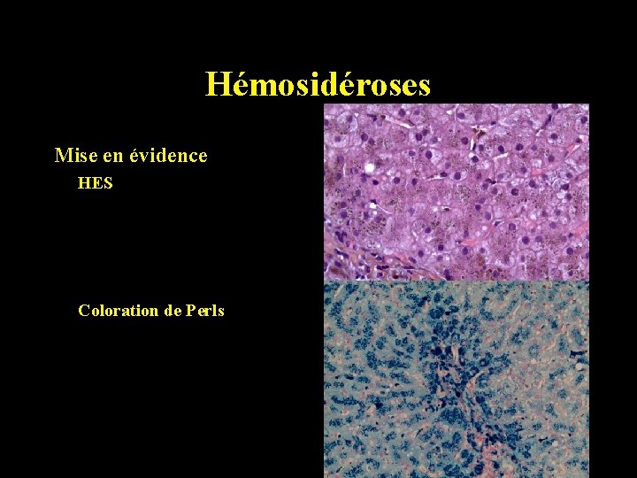 Hémosidéroses Mise en évidence HES Coloration de Perls 