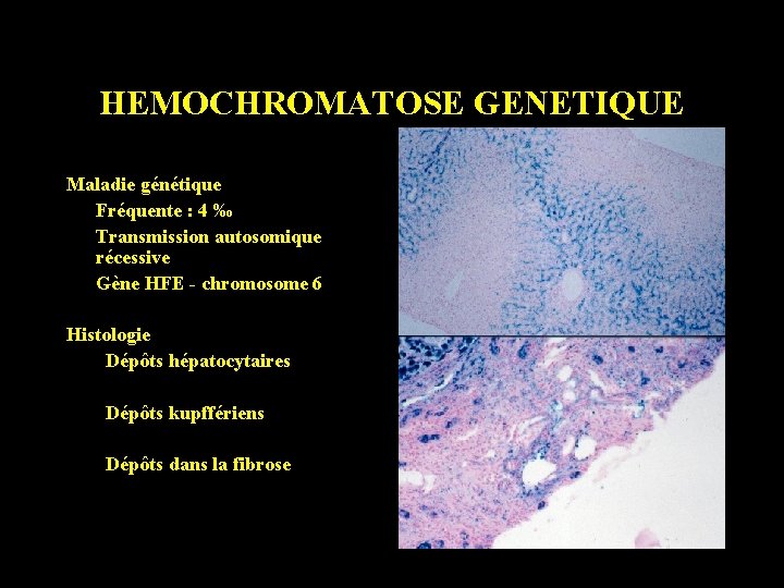 HEMOCHROMATOSE GENETIQUE Maladie génétique Fréquente : 4 ‰ Transmission autosomique récessive Gène HFE -