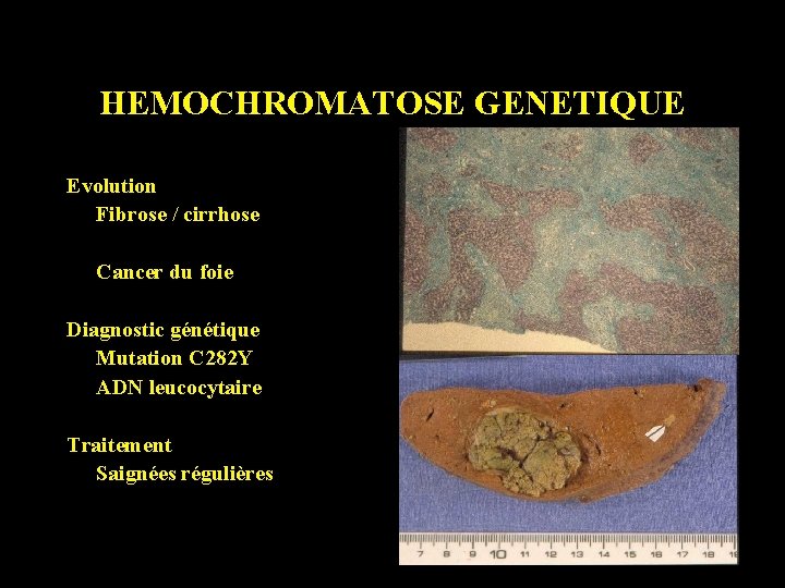 HEMOCHROMATOSE GENETIQUE Evolution Fibrose / cirrhose Cancer du foie Diagnostic génétique Mutation C 282