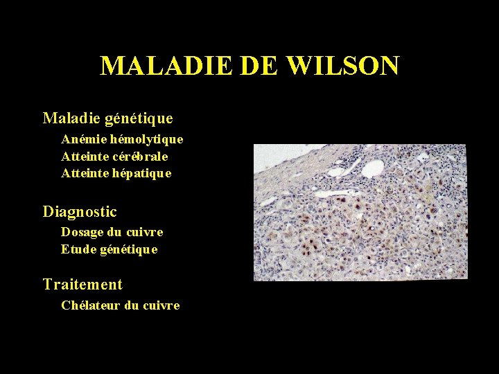 MALADIE DE WILSON Maladie génétique Anémie hémolytique Atteinte cérébrale Atteinte hépatique Diagnostic Dosage du