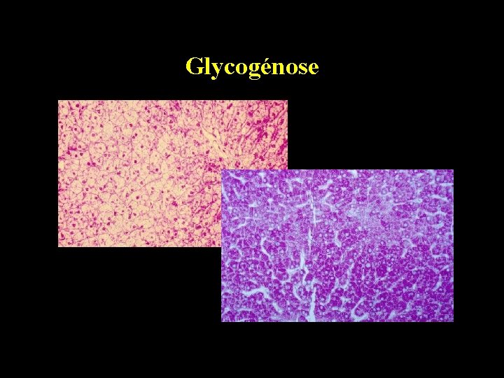 Glycogénose 
